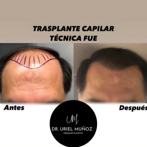 FUE Hair Transplant Mexico.png