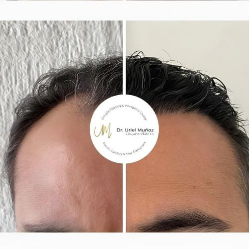 Hair Transplant Surgery In Puerto Vallarta Mexico Cost